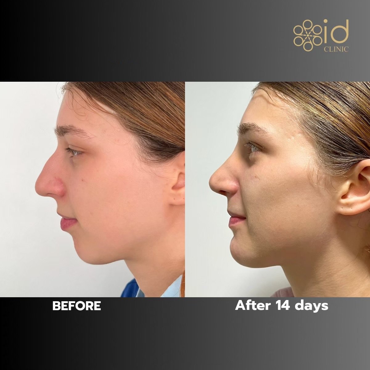 نتائج قبل وبعد زراعة الذقن في ID Clinic Bangkok، تحسين مظهر الذقن خلال 14 يومًا