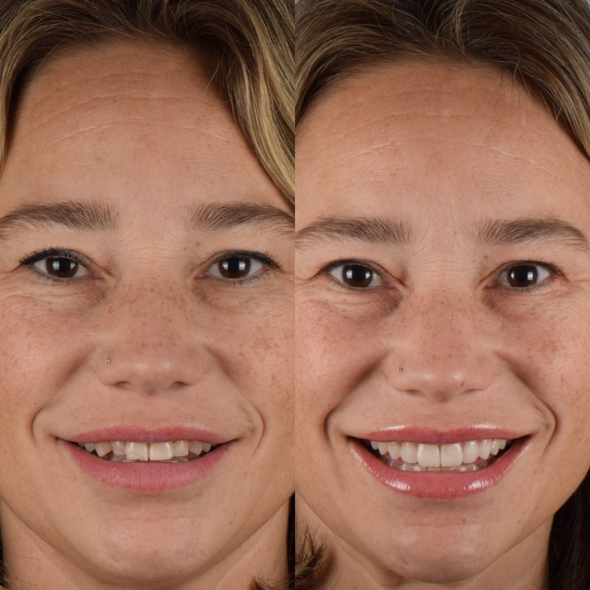 Antes y después de carillas en DR. BİRKAN DURAS CLINIC – sonrisa natural y renovada
