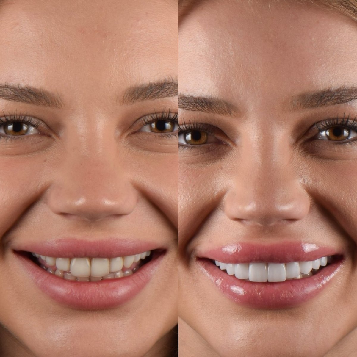 قبل وبعد الفينير في DR. BİRKAN DURAS CLINIC – ابتسامة طبيعية وجذابة