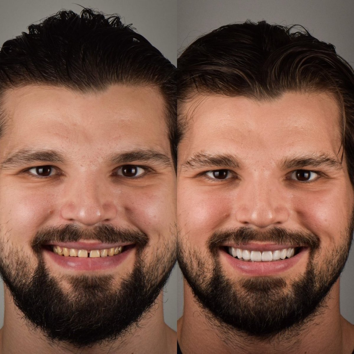 Antes y después de carillas dentales en DR. BİRKAN DURAS CLINIC – sonrisa natural