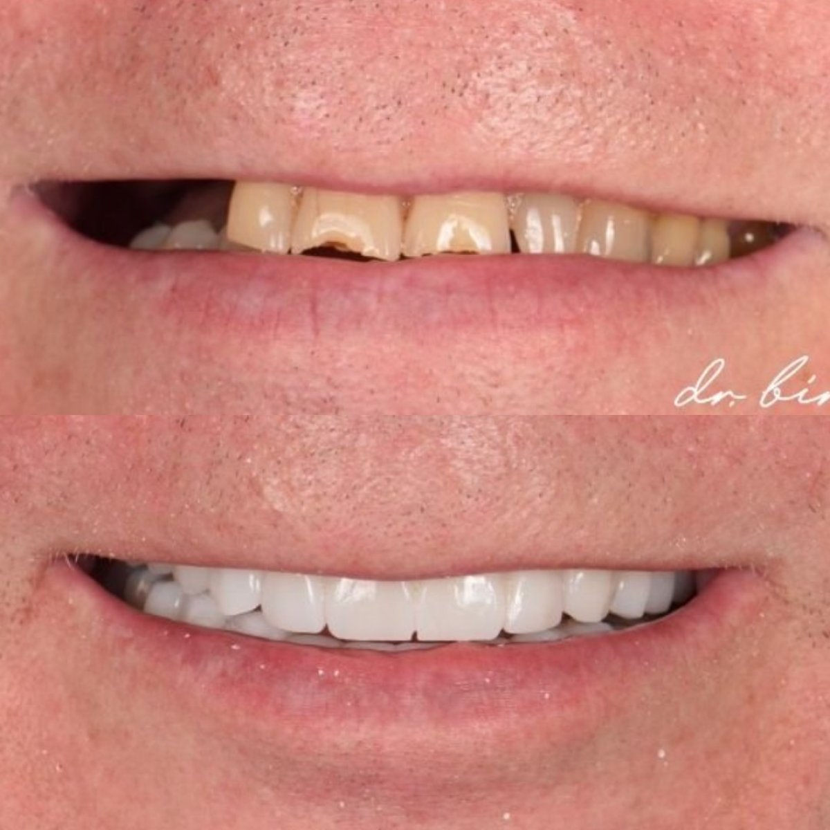 نتائج قبل وبعد طقم الأسنان في DR. BİRKAN DURAS CLINIC – ابتسامة مستعادة
