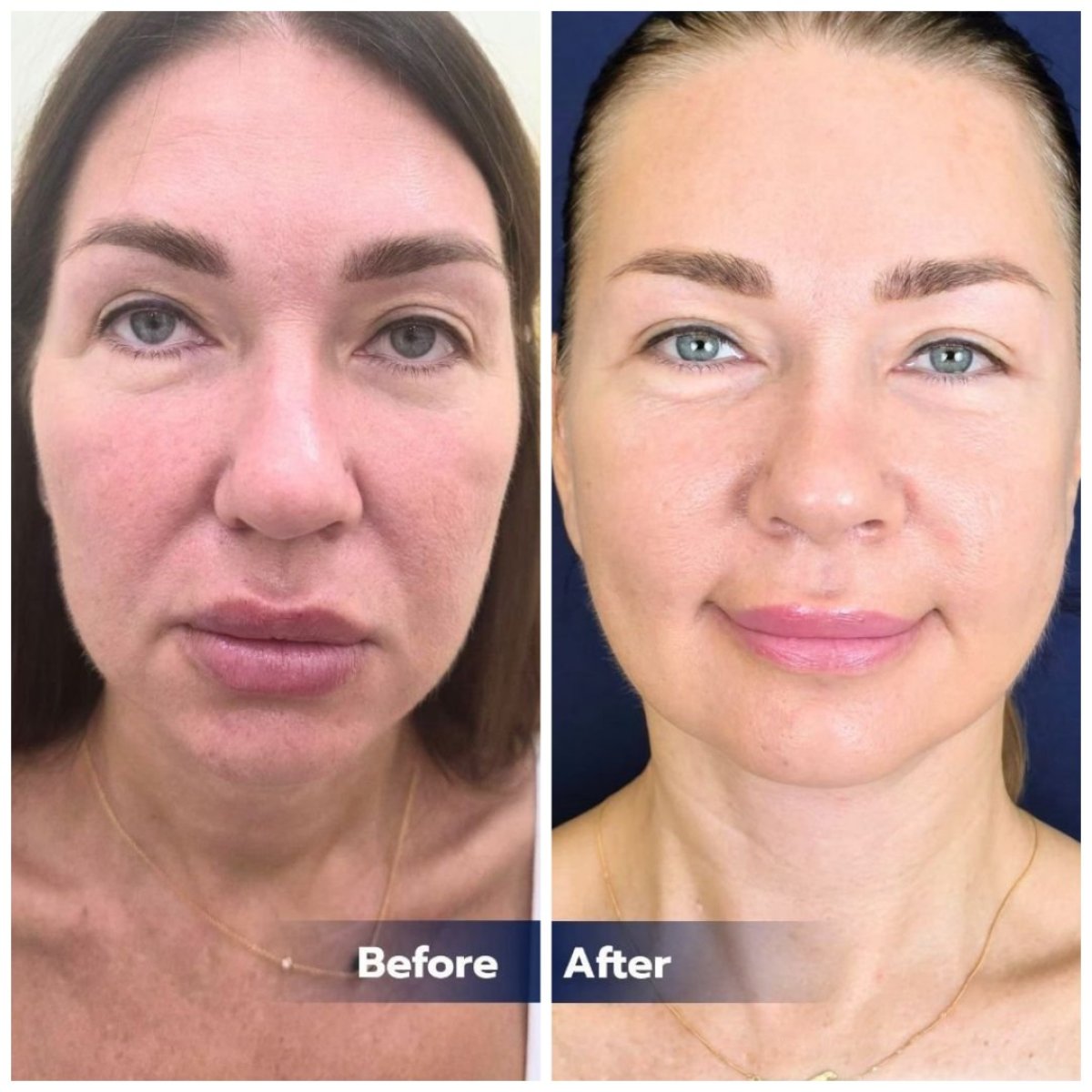 Resultados antes y después de deep plane facelift en Intrarat Hospital – rejuvenecimiento facial