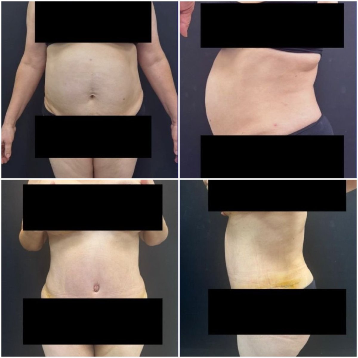 Efekty liposukcji brzucha przed i po w klinice Dr. Fabiano Arruda – Plastic Surgery