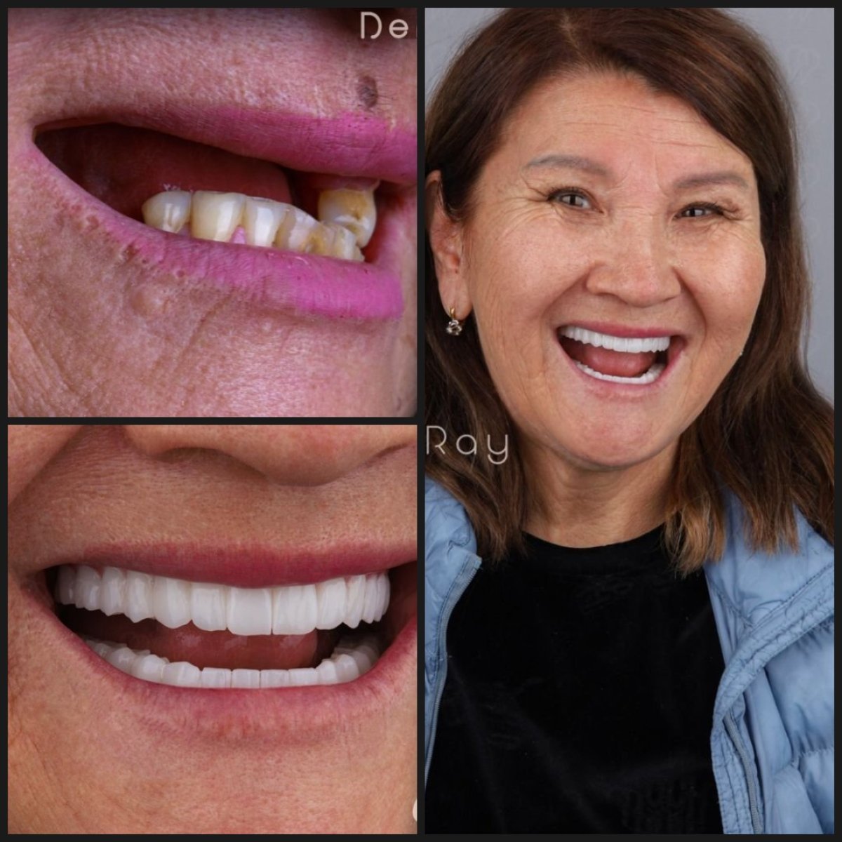 نتائج قبل وبعد زراعة الأسنان All-on-4 في عيادة Dentaray، استعادة الابتسامة
