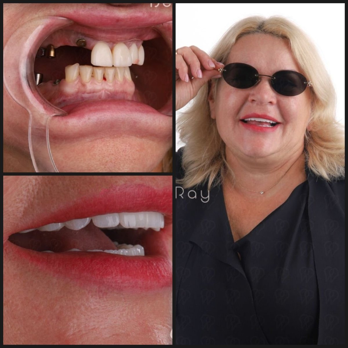 Resultados antes y después de implantes All-on-4 en Dentaray Clinic, restauración de sonrisa