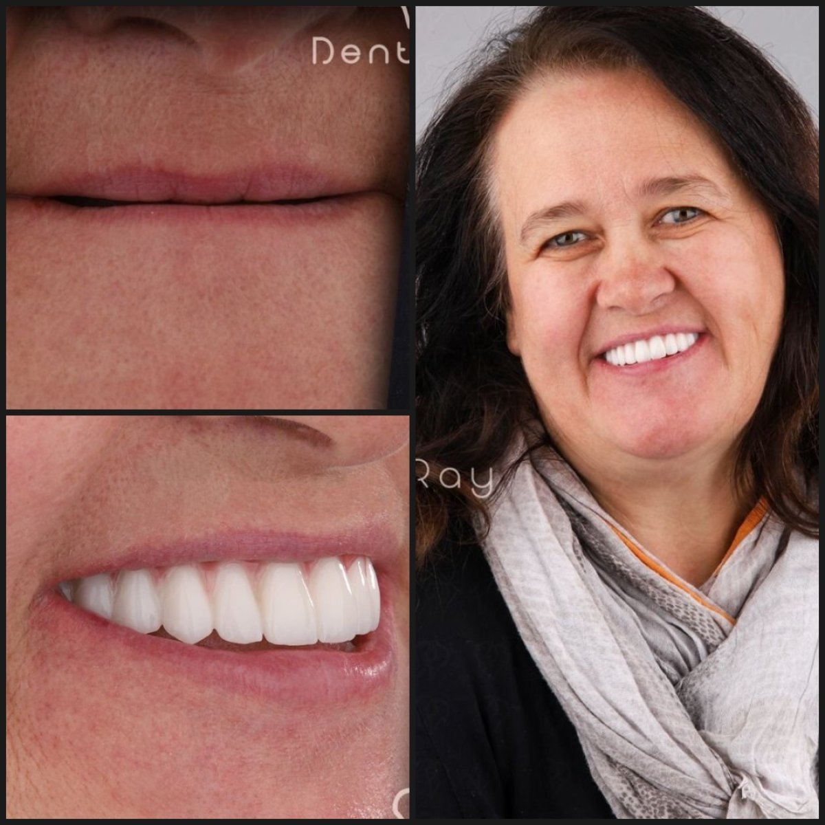 Resultado antes y después de implantes All-on-4 en Dentaray Clinic, restauración de sonrisa