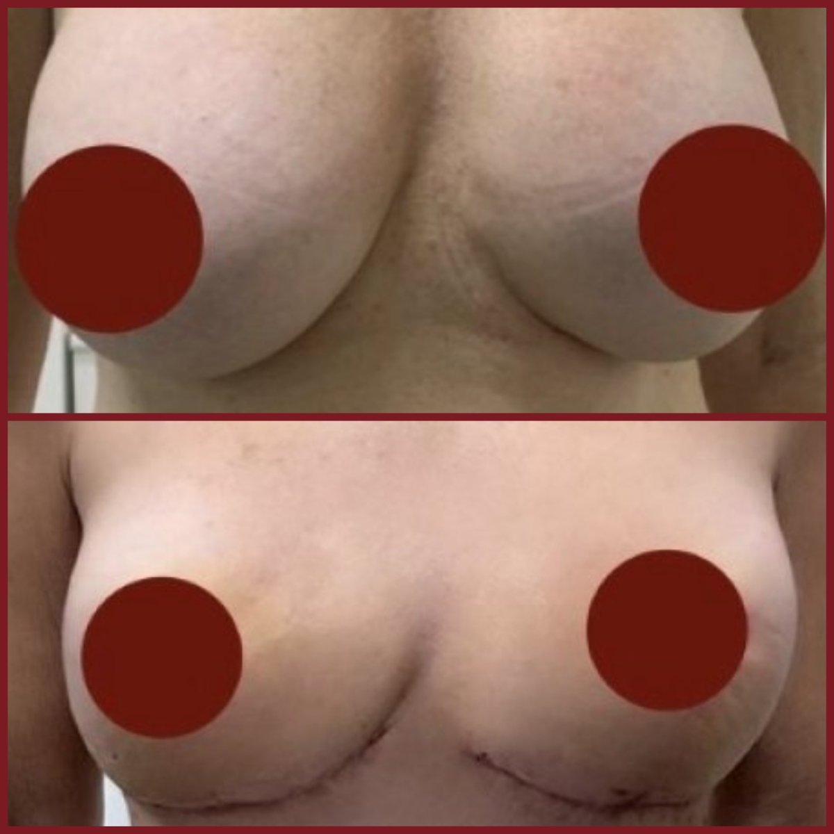 Before and after breast implant removal results at DGB Clinic, natural breast contour restored