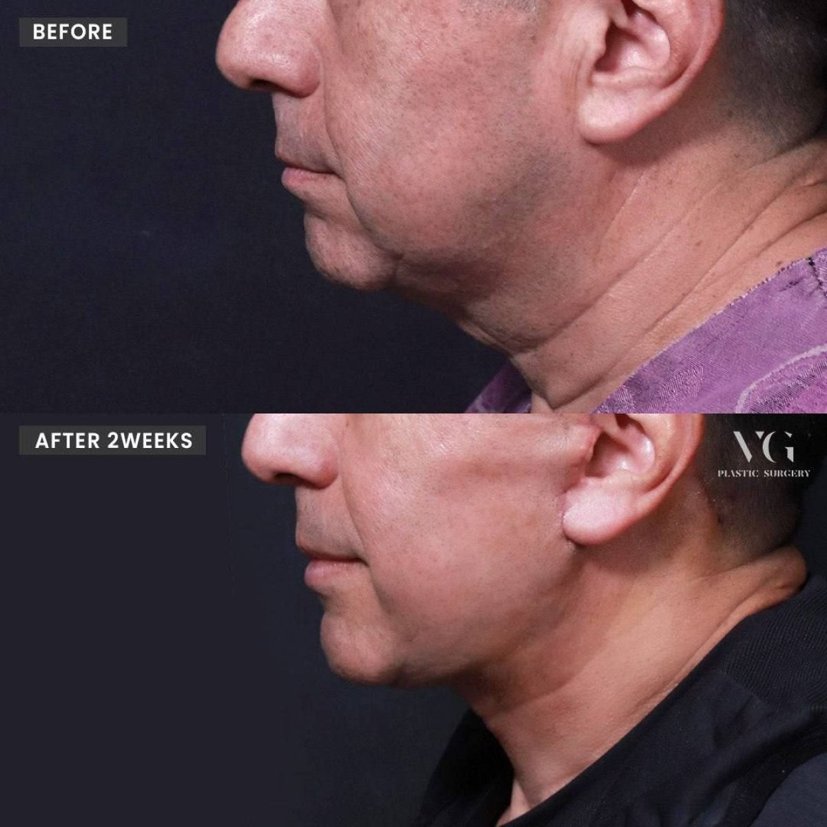 Before and after double chin liposuction results at VG Plastic Surgery, improved jawline contour
