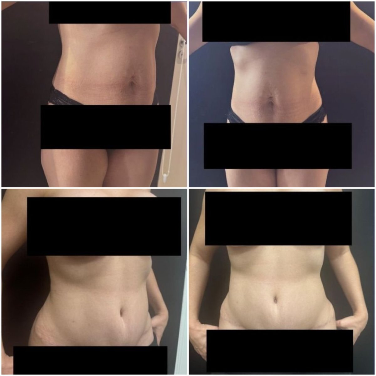 نتائج شد البطن والشفط قبل وبعد في Dr. Fabiano Arruda – Plastic Surgery