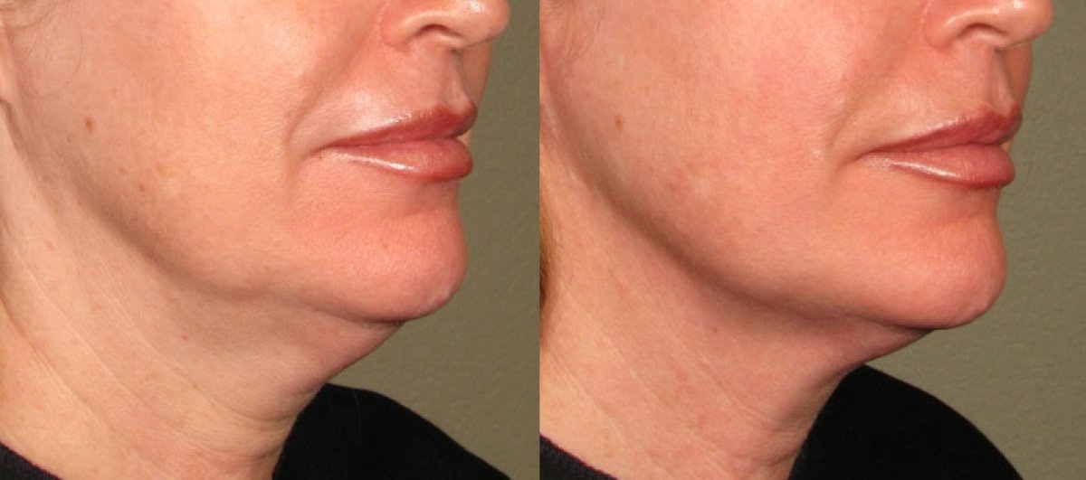 Before and after Ultherapy results at Altos Clinic – visible jawline and neck tightening
