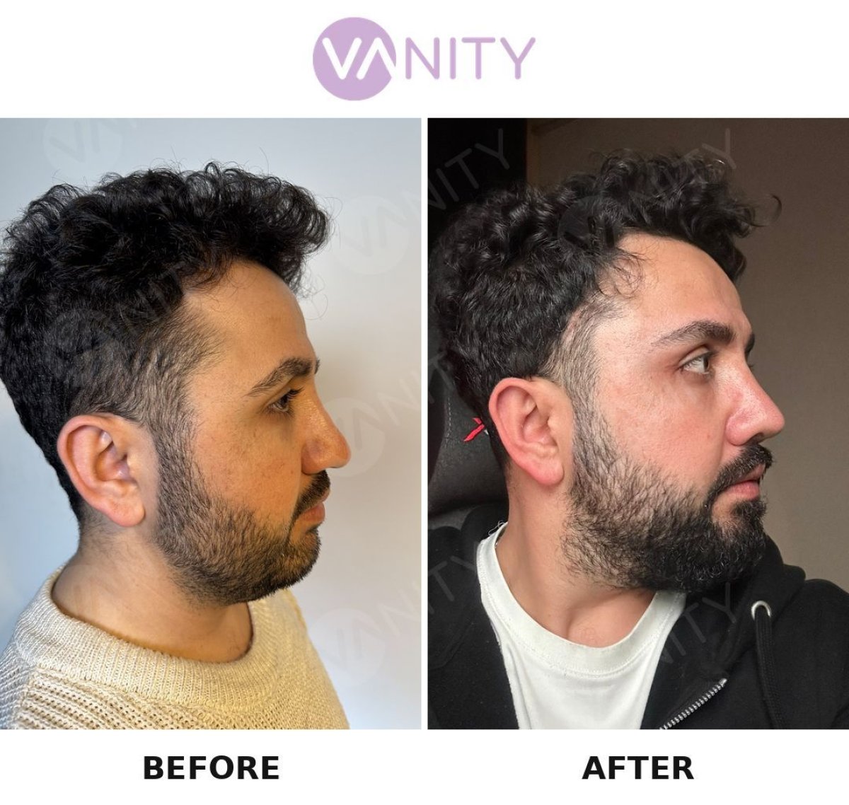 Resultados de rinoplastia antes y después en Vanity Cosmetic Surgery Center, perfil nasal mejorado