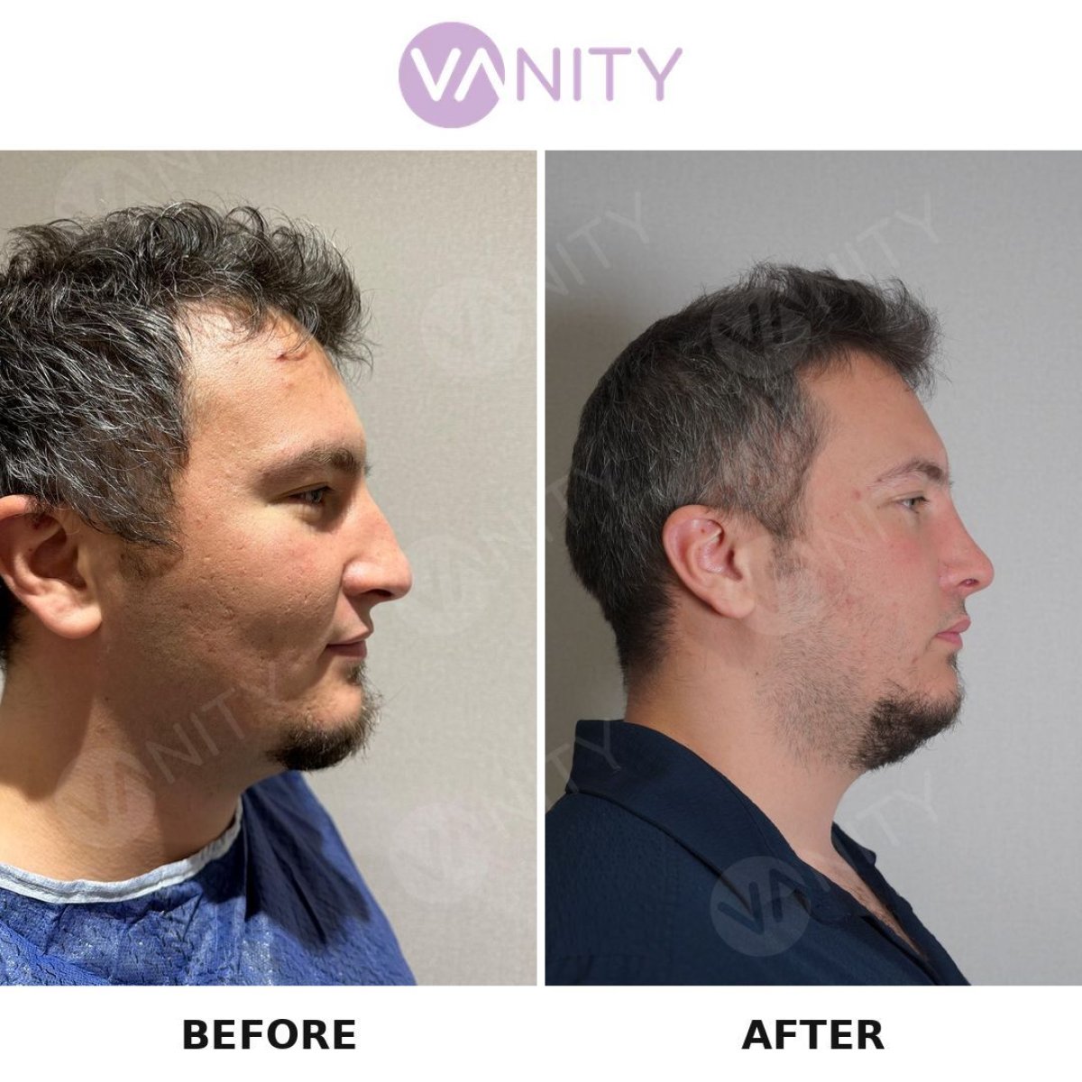 Before and after rhinoplasty results at Vanity Cosmetic Surgery Center, improved nose profile