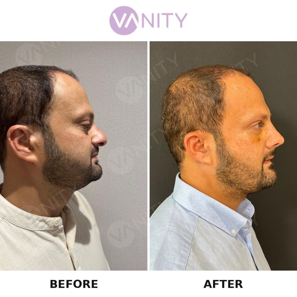 Resultados de trasplante capilar FUE antes y después en Vanity Cosmetic Surgery Center, línea mejorada