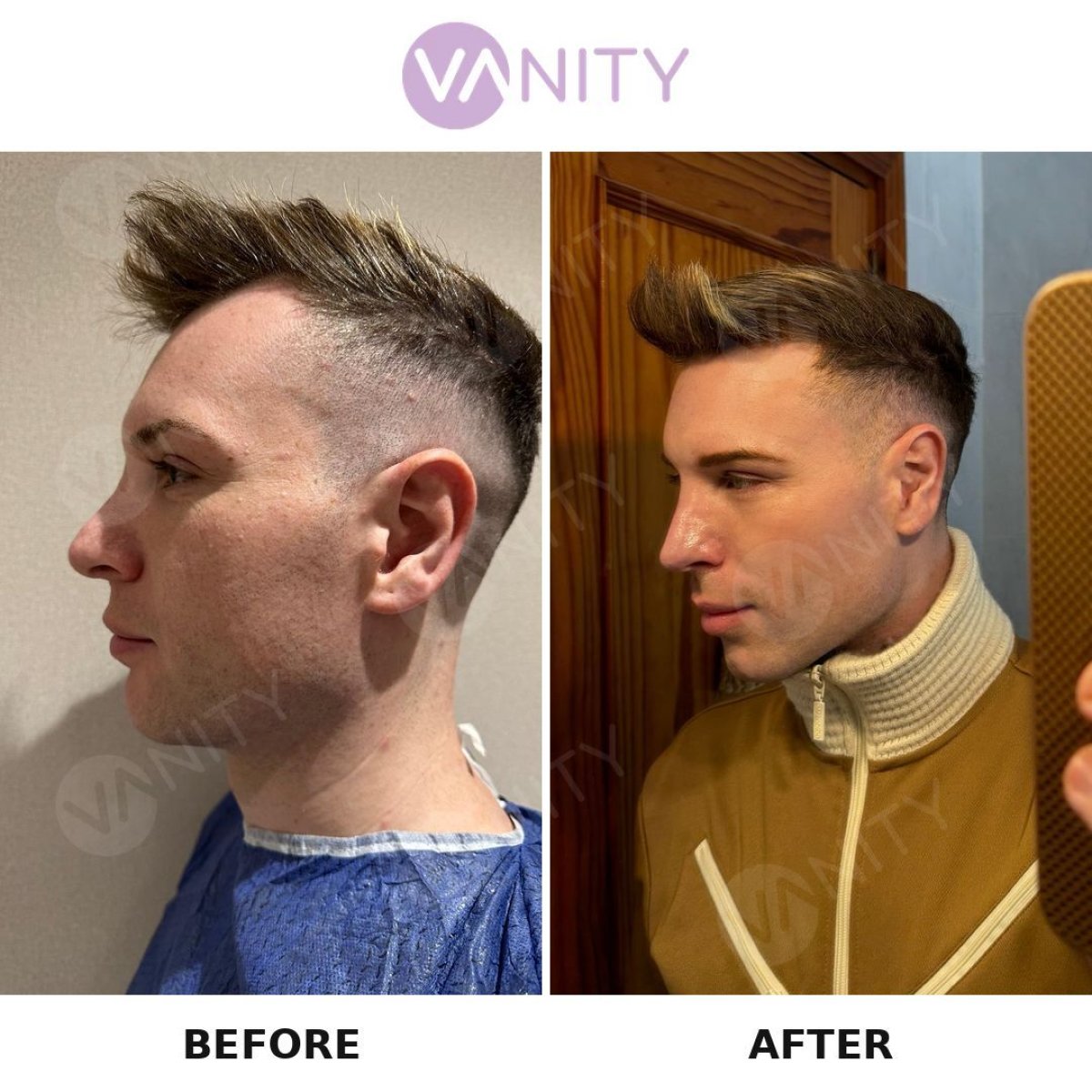 Resultados de rinoplastia antes y después en Vanity Cosmetic Surgery Center, perfil nasal mejorado