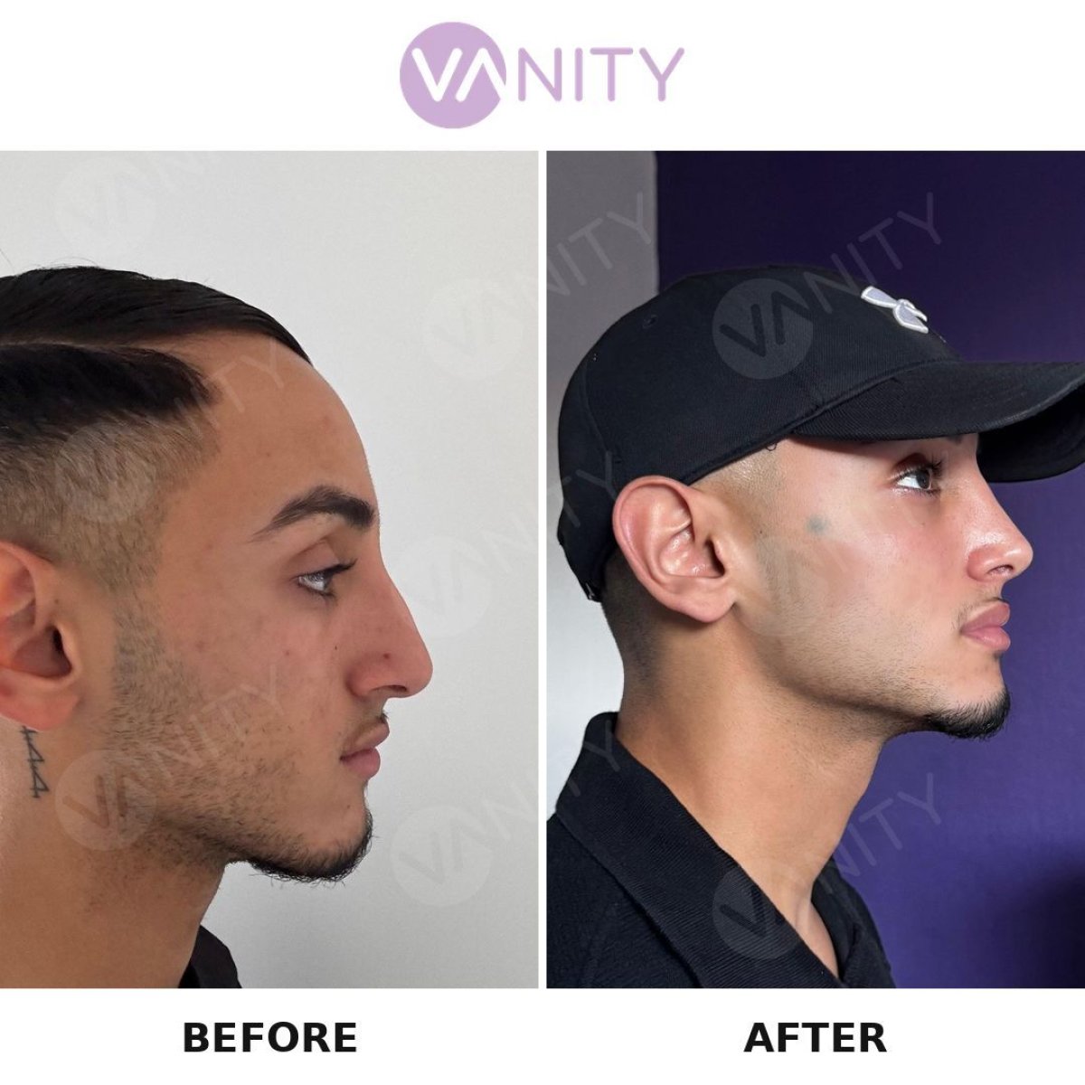Resultados de rinoplastia antes y después en Vanity Cosmetic Surgery Center, perfil nasal mejorado