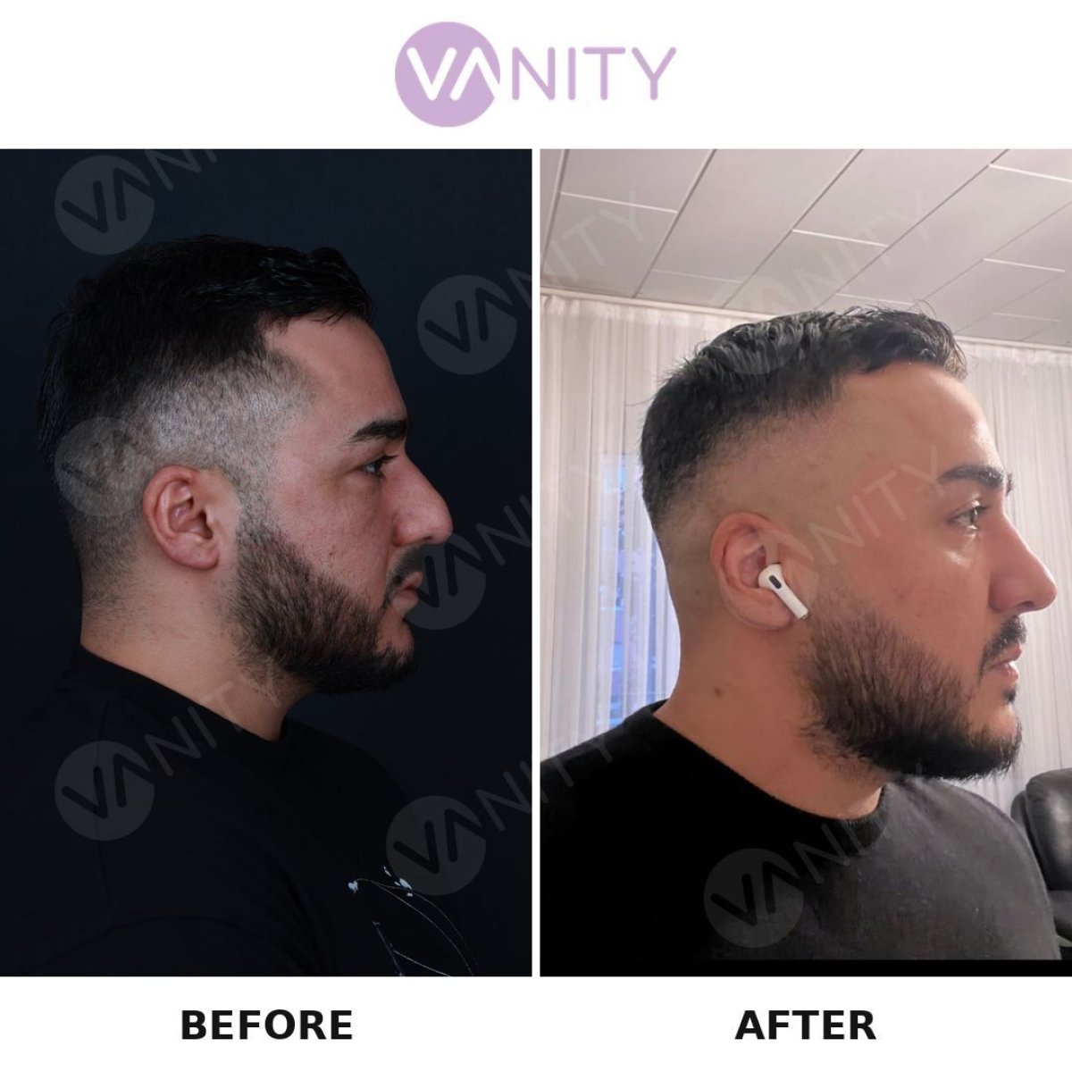 Resultados de rinoplastia antes y después en Vanity Cosmetic Surgery Center, perfil nasal mejorado