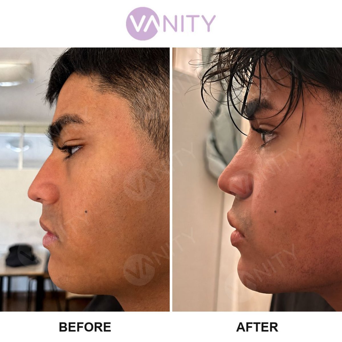 Resultados de rinoplastia antes y después en Vanity Cosmetic Surgery Center, perfil nasal mejorado