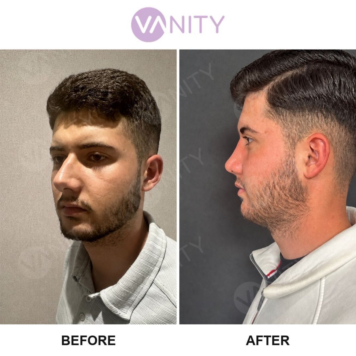 Resultado de rinoplastia antes y después en Vanity Cosmetic Surgery Center, perfil nasal mejorado