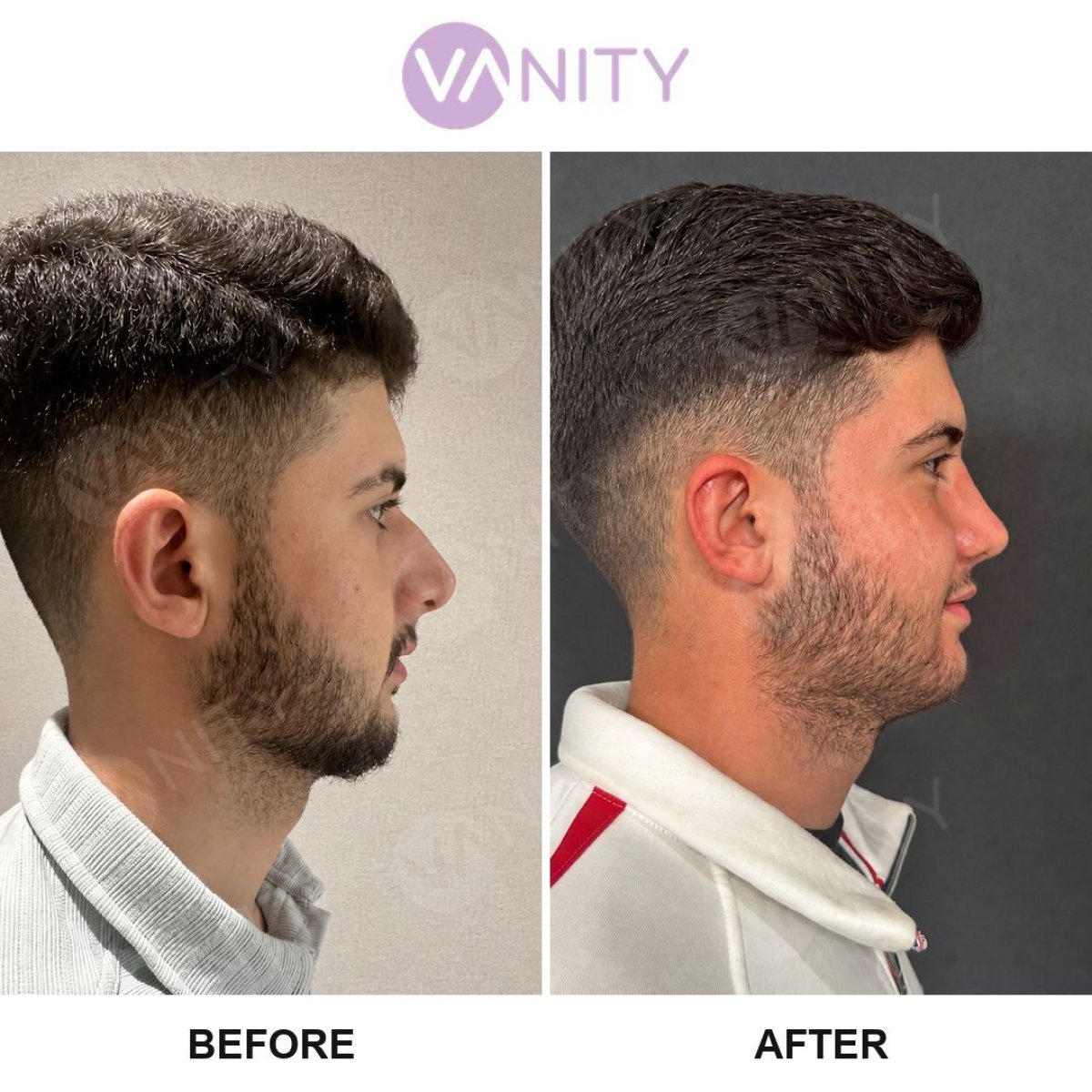 Resultados de rinoplastia antes y después en Vanity Cosmetic Surgery Center, perfil nasal mejorado