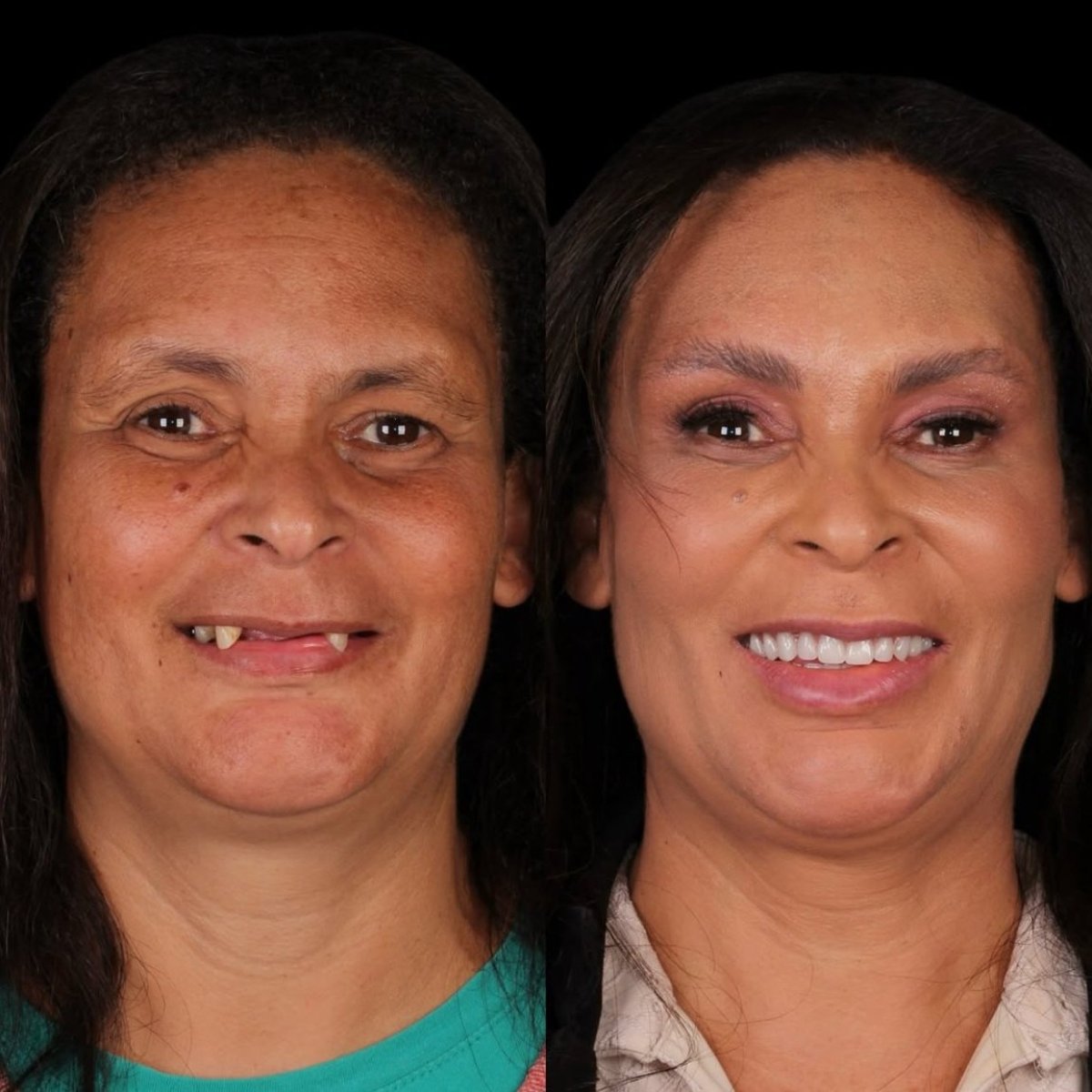 Resultado antes y después de carillas en DentVisit — Istanbul Dental Care, cambio de sonrisa