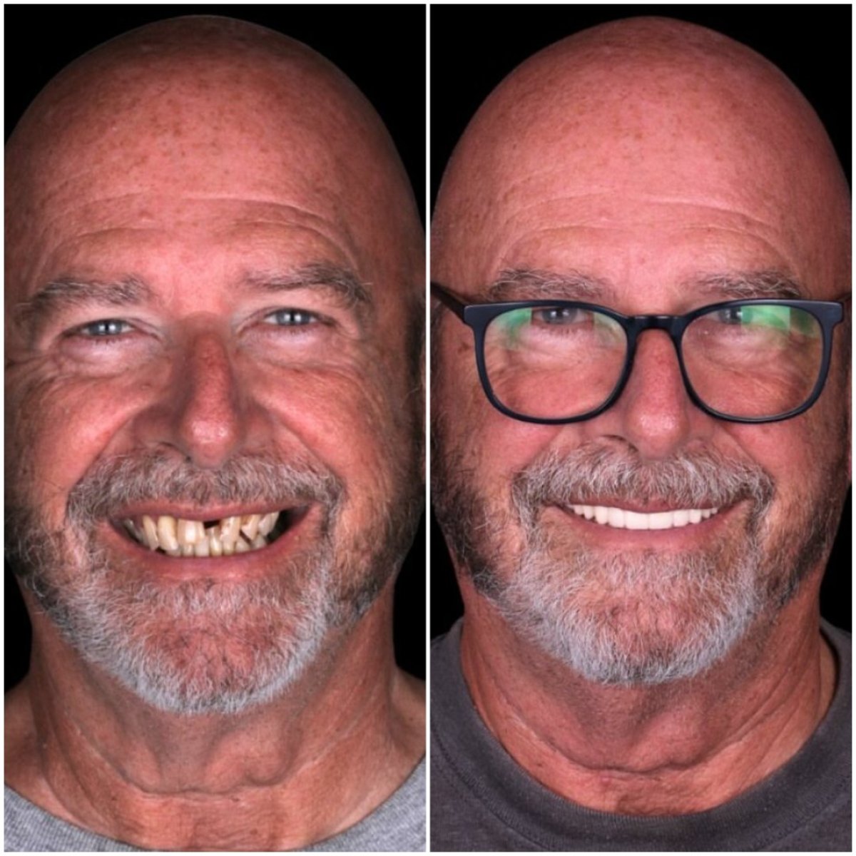 Resultado antes y después de carillas en DentVisit — Istanbul Dental Care, cambio de sonrisa masculina