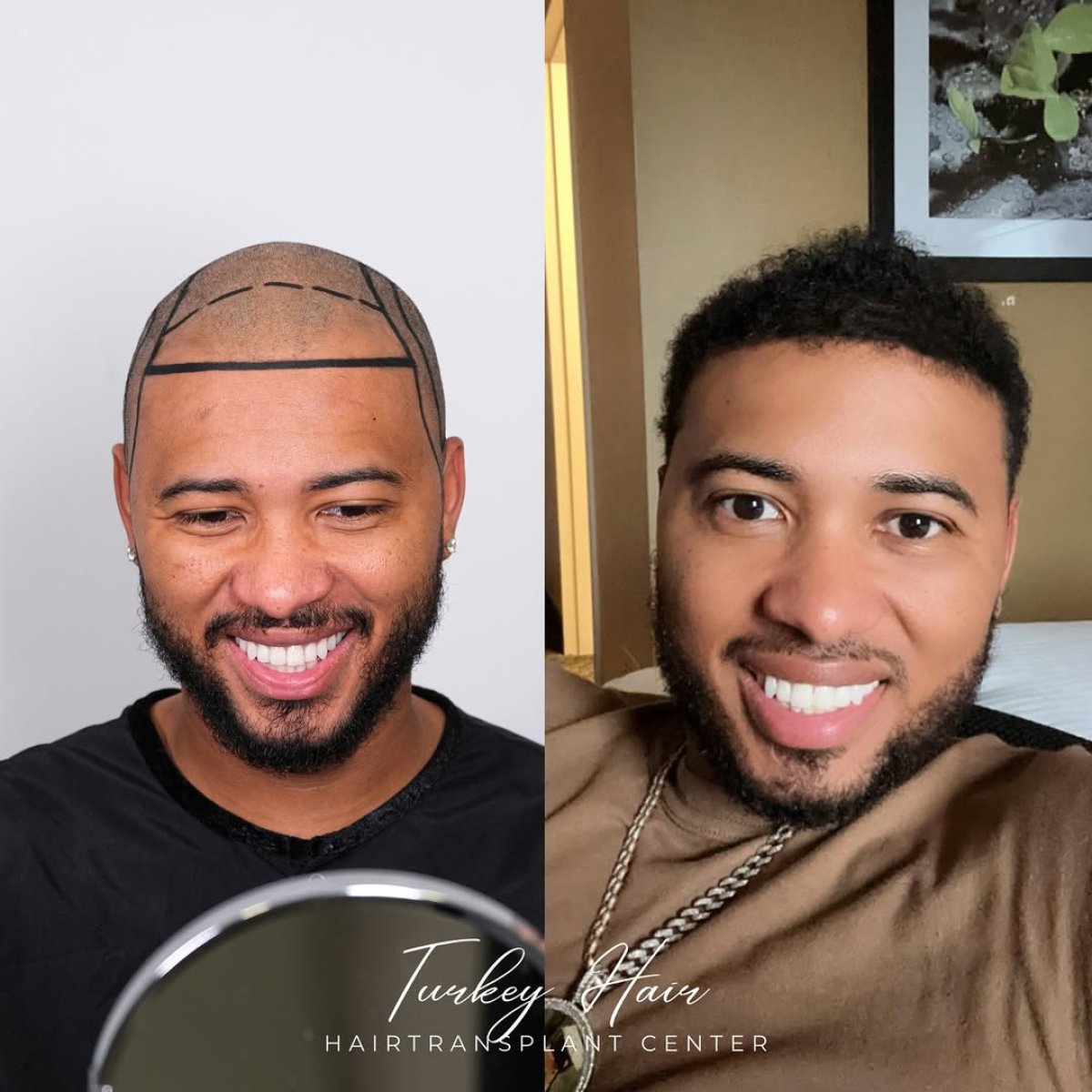 Resultado antes y después de trasplante capilar Sapphire FUE en Turkey Hair Transplant Center