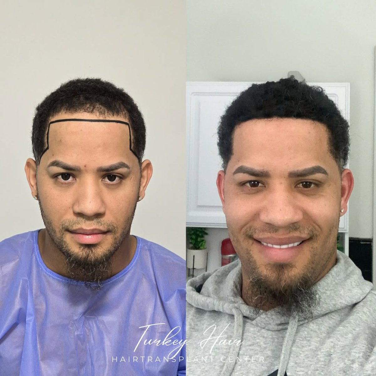 Resultado antes y después de trasplante capilar Sapphire FUE en Turkey Hair Transplant Center
