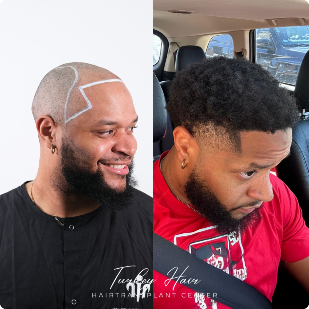 Resultado antes y después de trasplante capilar Sapphire FUE en Turkey Hair Transplant Center