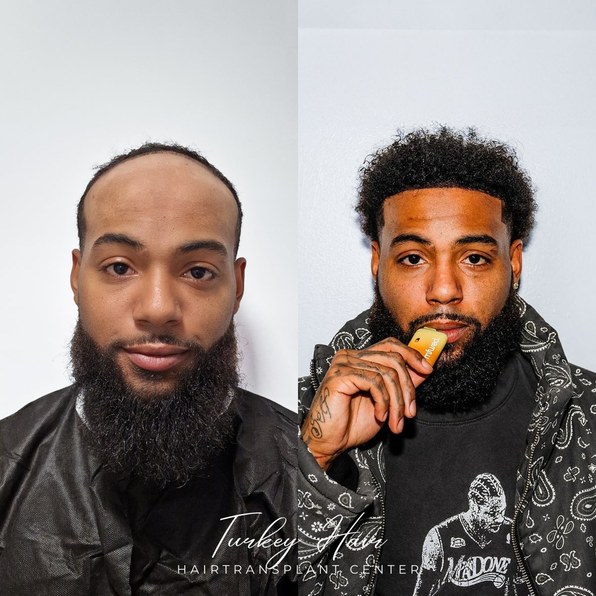 Resultado antes y después de trasplante capilar Sapphire FUE en Turkey Hair Transplant Center