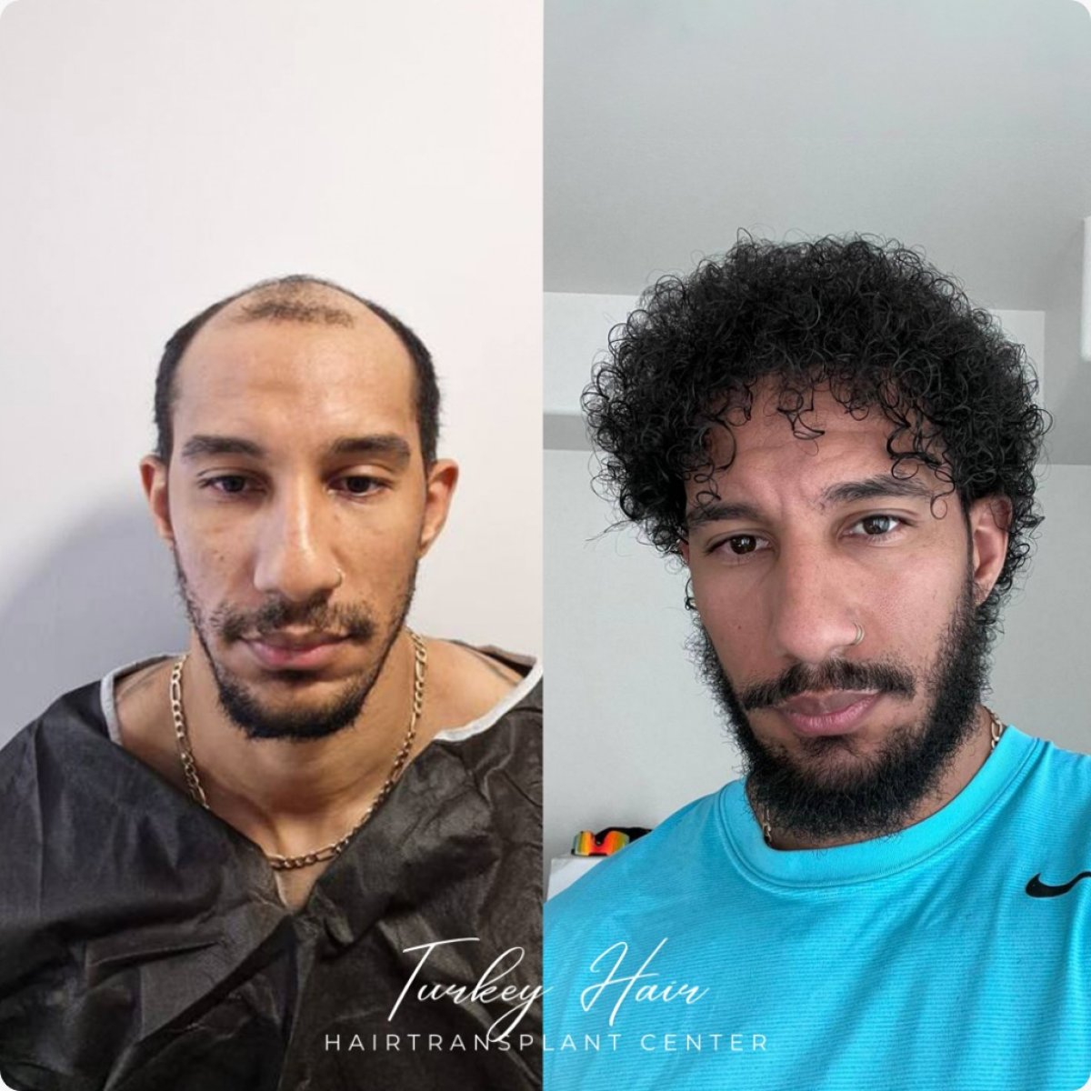 Resultado antes y después de trasplante capilar Sapphire FUE en Turkey Hair Transplant Center
