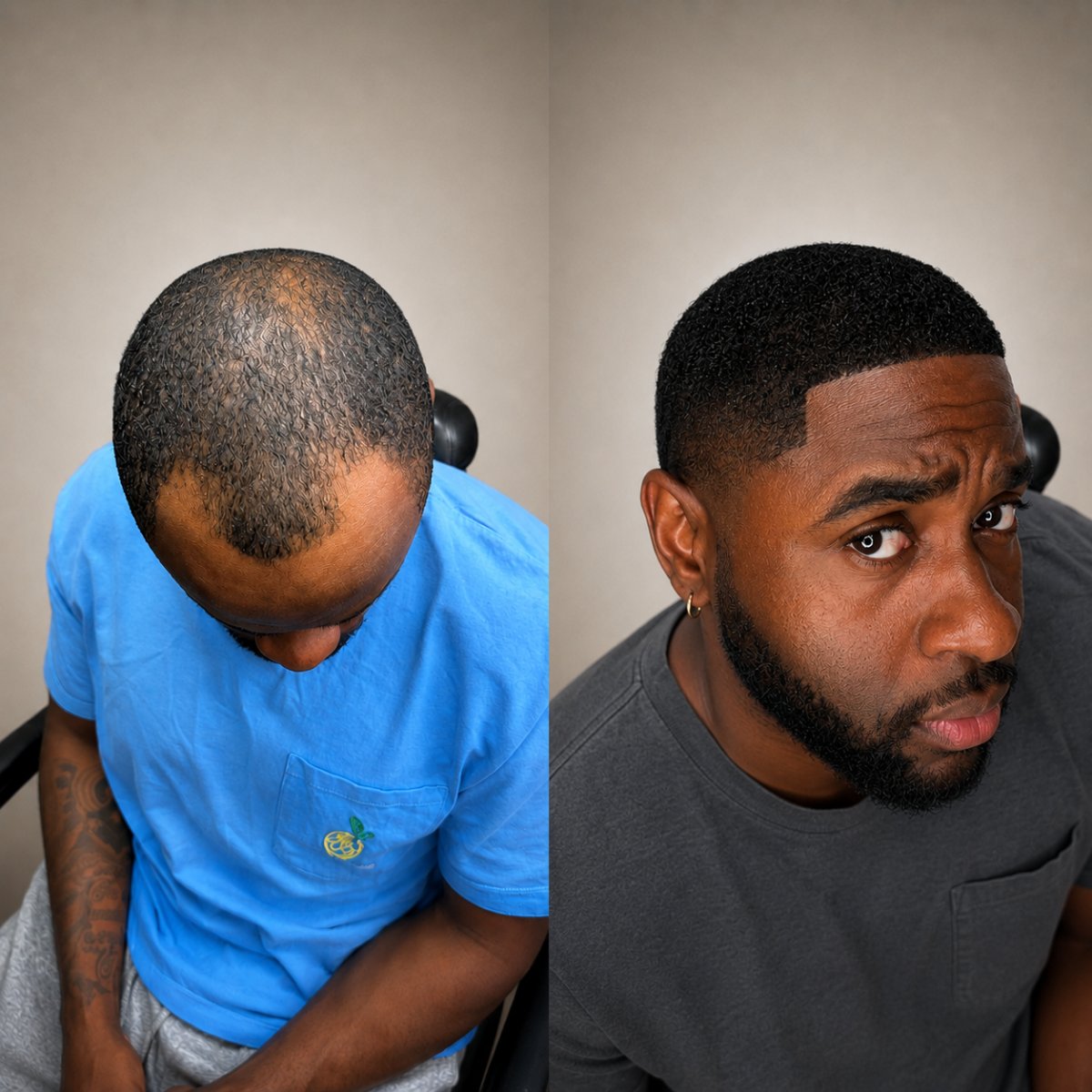 Before and after Sapphire FUE hair transplant result at Turkey Hair Transplant Center