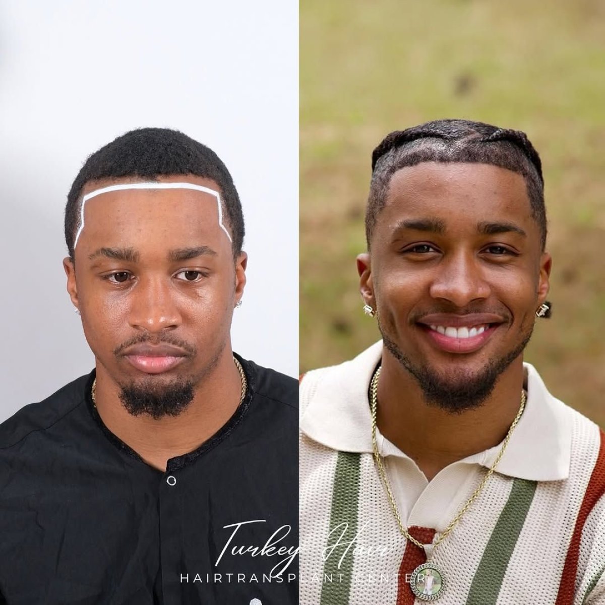 Resultado antes y después de trasplante de cabello afro en Turkey Hair Transplant Center, línea restaurada
