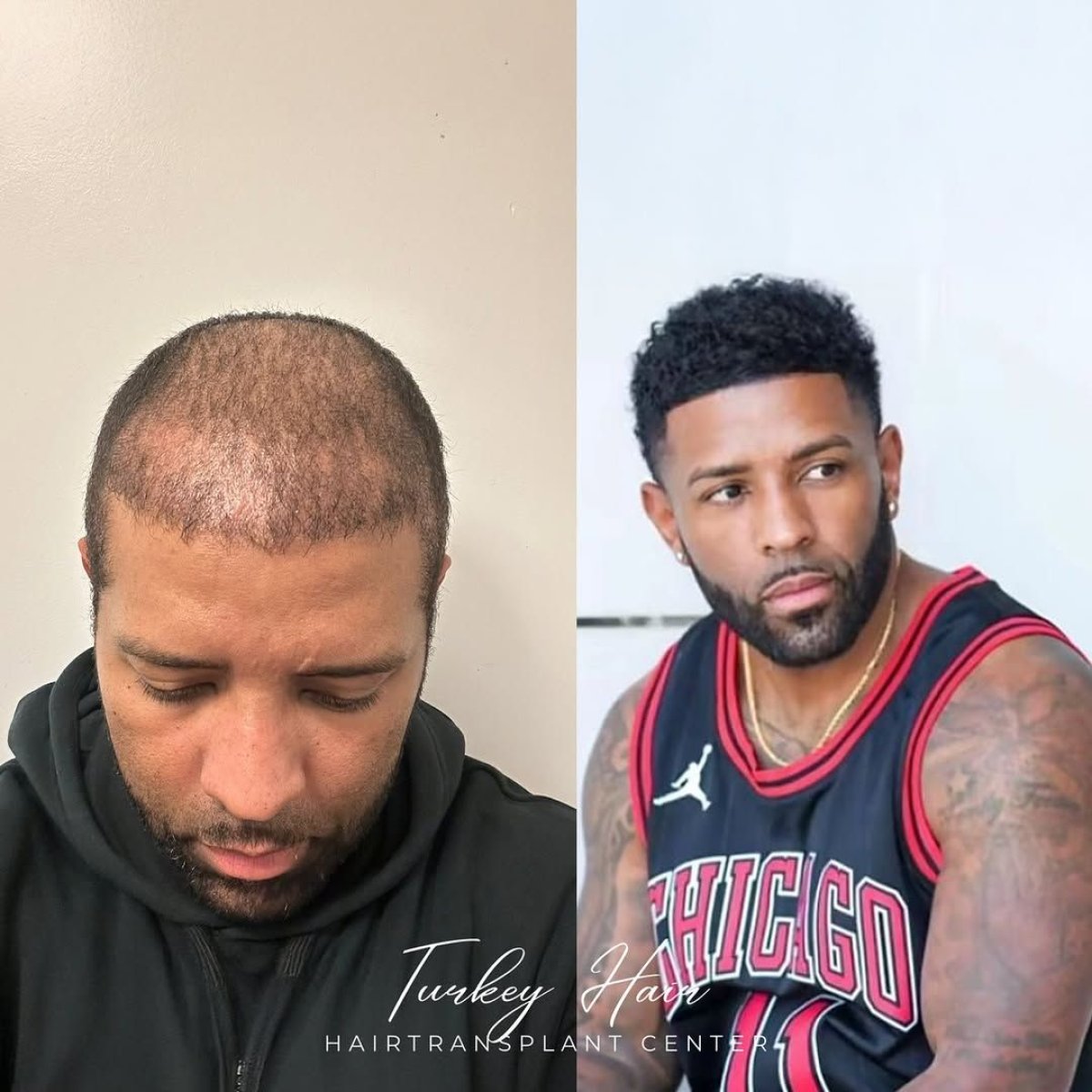 Resultados de trasplante de cabello afro antes y después en Turkey Hair Transplant Center, línea capilar más densa