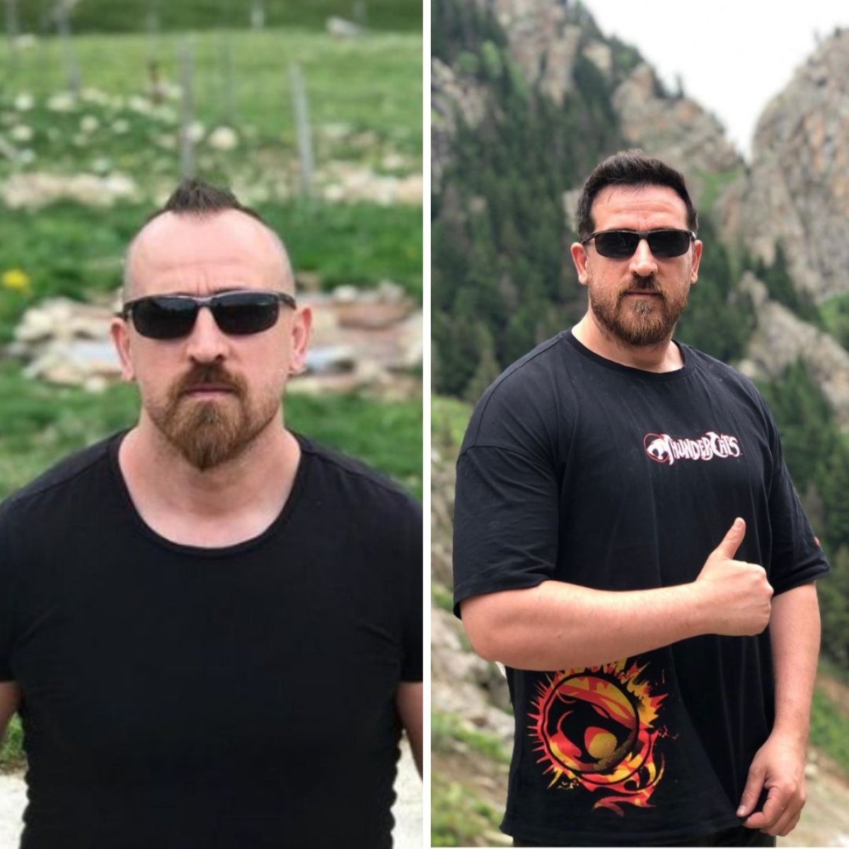Resultado antes y después de trasplante capilar DHI en Turkey Hair Transplant Center, línea restaurada