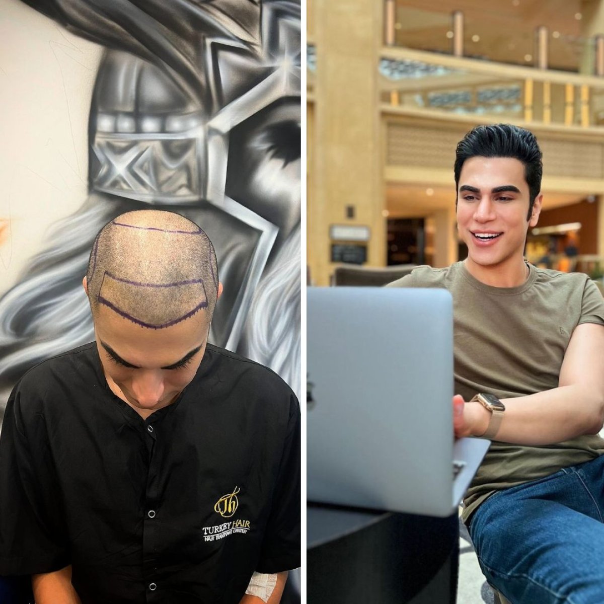 Resultado antes y después de trasplante capilar DHI en Turkey Hair Transplant Center, línea restaurada