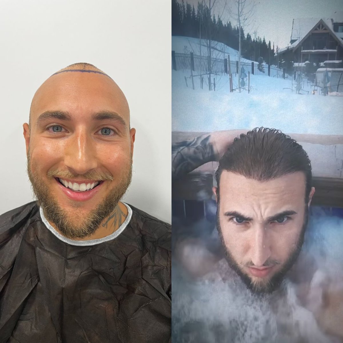Resultado antes y después de trasplante capilar DHI en Turkey Hair Transplant Center, línea restaurada