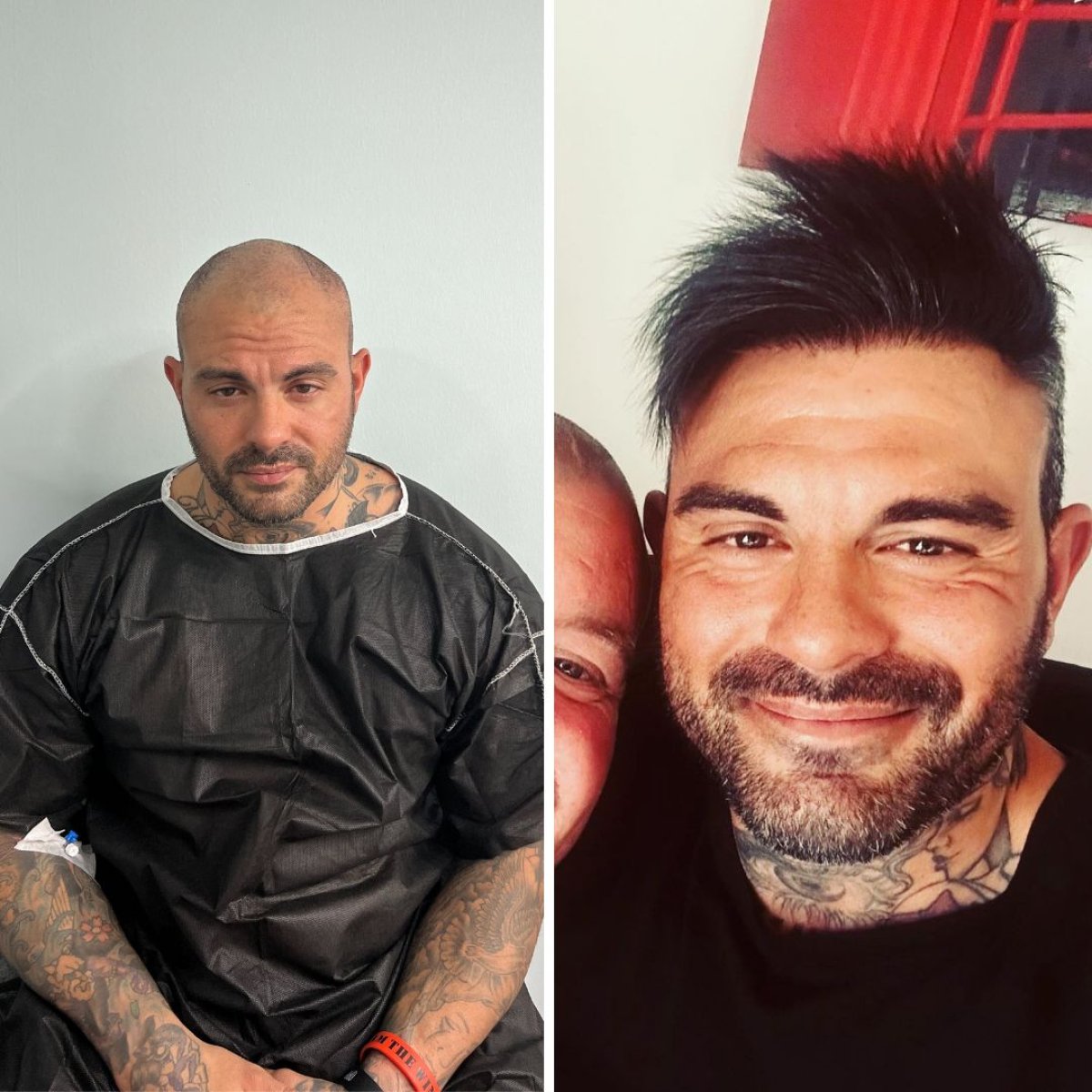 Resultado antes y después de trasplante capilar DHI en Turkey Hair Transplant Center, línea restaurada