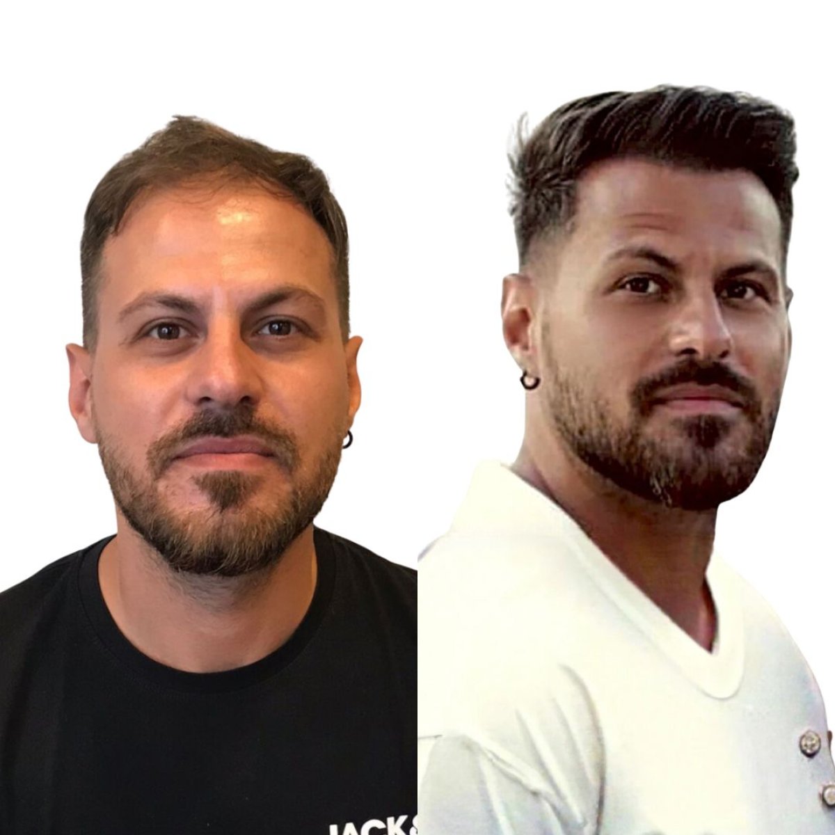 Resultado antes y después de trasplante capilar DHI en Turkey Hair Transplant Center, línea mejorada