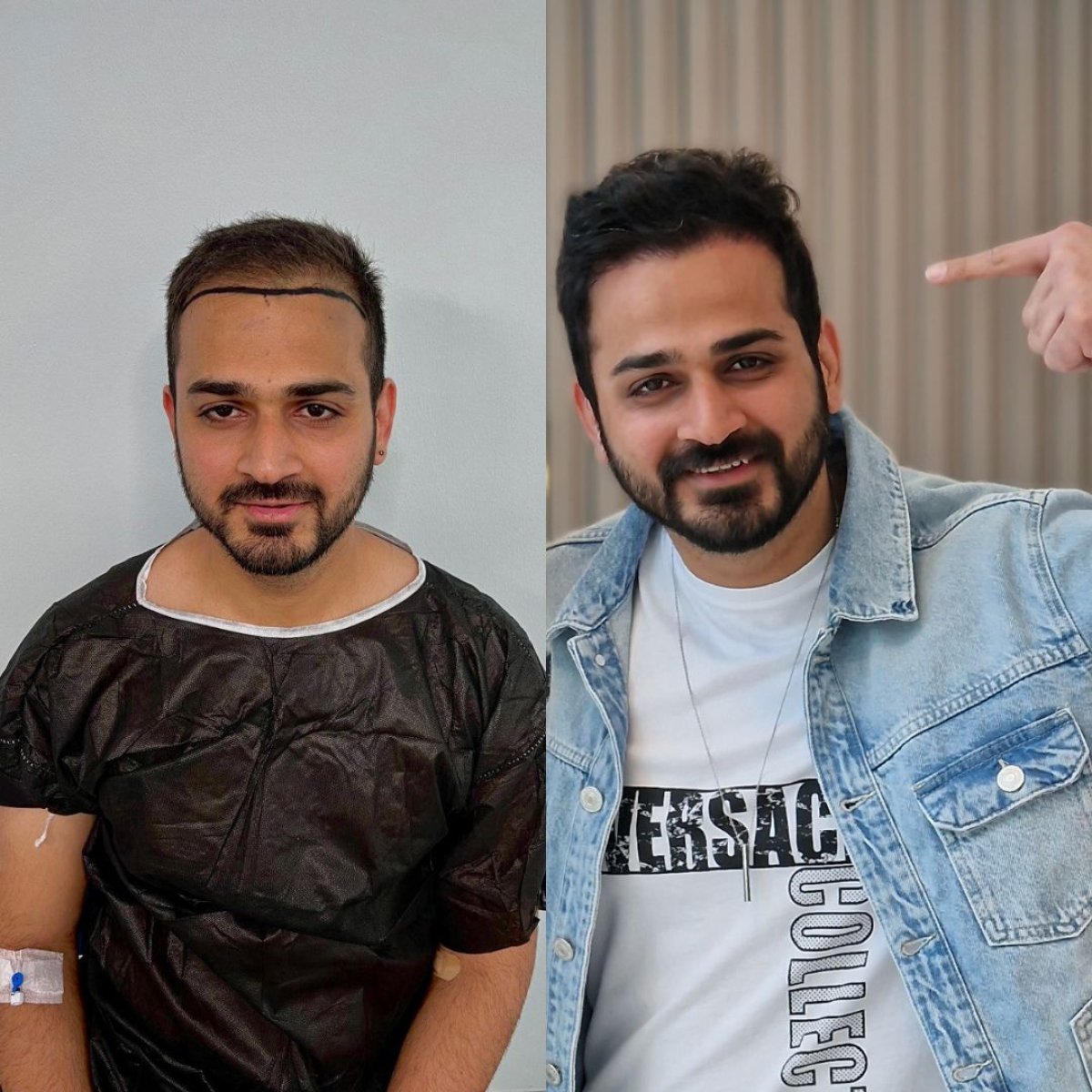 Resultados antes y después de trasplante capilar DHI en Turkey Hair Transplant Center, línea mejorada