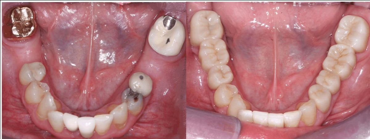 Before and after zirconia dental bridge results at SoftDentalCare Clinic, restored lower teeth