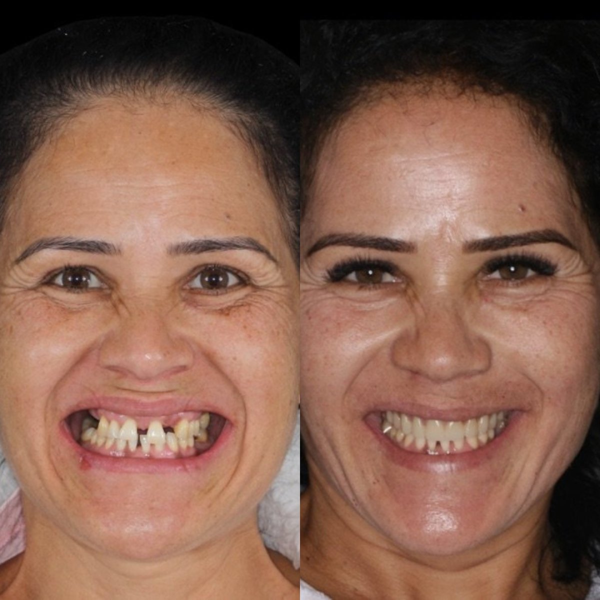 نتيجة قبل وبعد زراعة الأسنان All-on-6 في Clínica Zago Dental Clinic، استعادة الابتسامة
