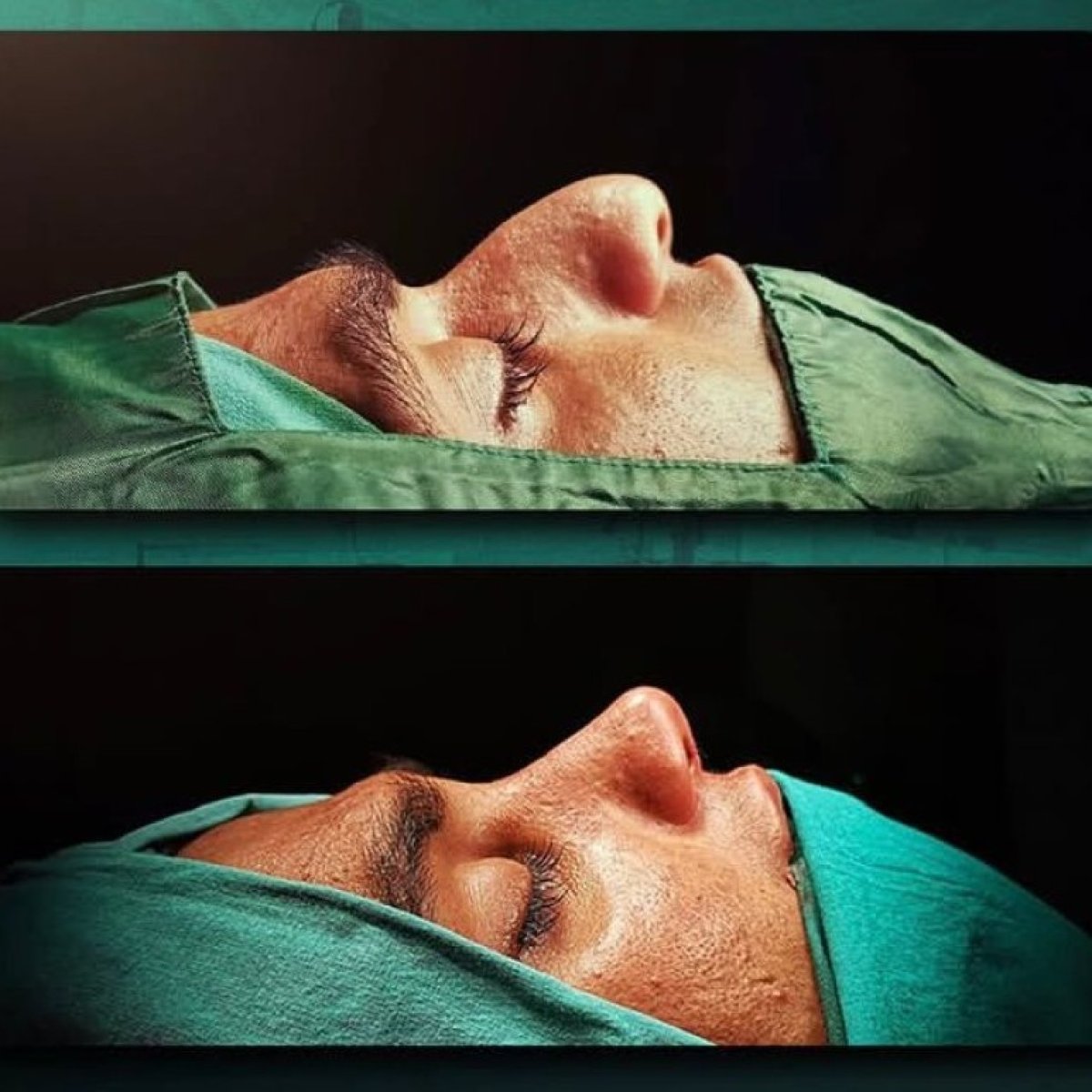 نتائج عملية تجميل الأنف قبل وبعد في Grand Clinic، تحسين شكل الأنف والملف الجانبي