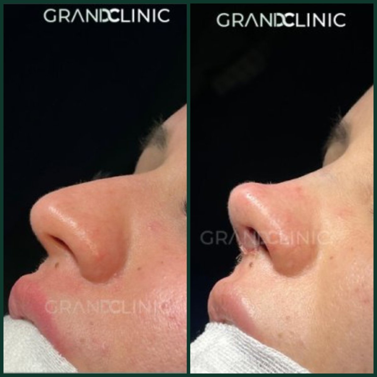 نتيجة عملية تجميل الأنف قبل وبعد في Grand Clinic، تحسين شكل الأنف والملف الجانبي