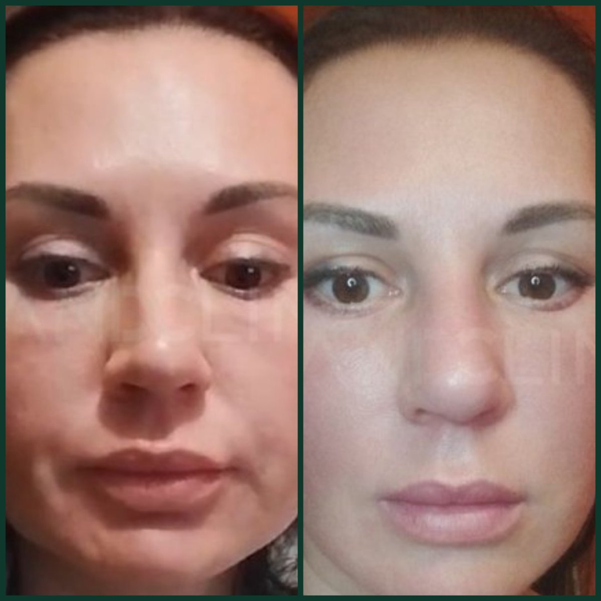 نتائج شد الوجه قبل وبعد في Grand Clinic – تجديد شباب الوجه وبشرة أكثر نعومة