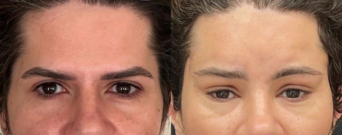 Resultados de lifting de frente antes y después en Dr. Safa Manav Clinic, frente más lisa