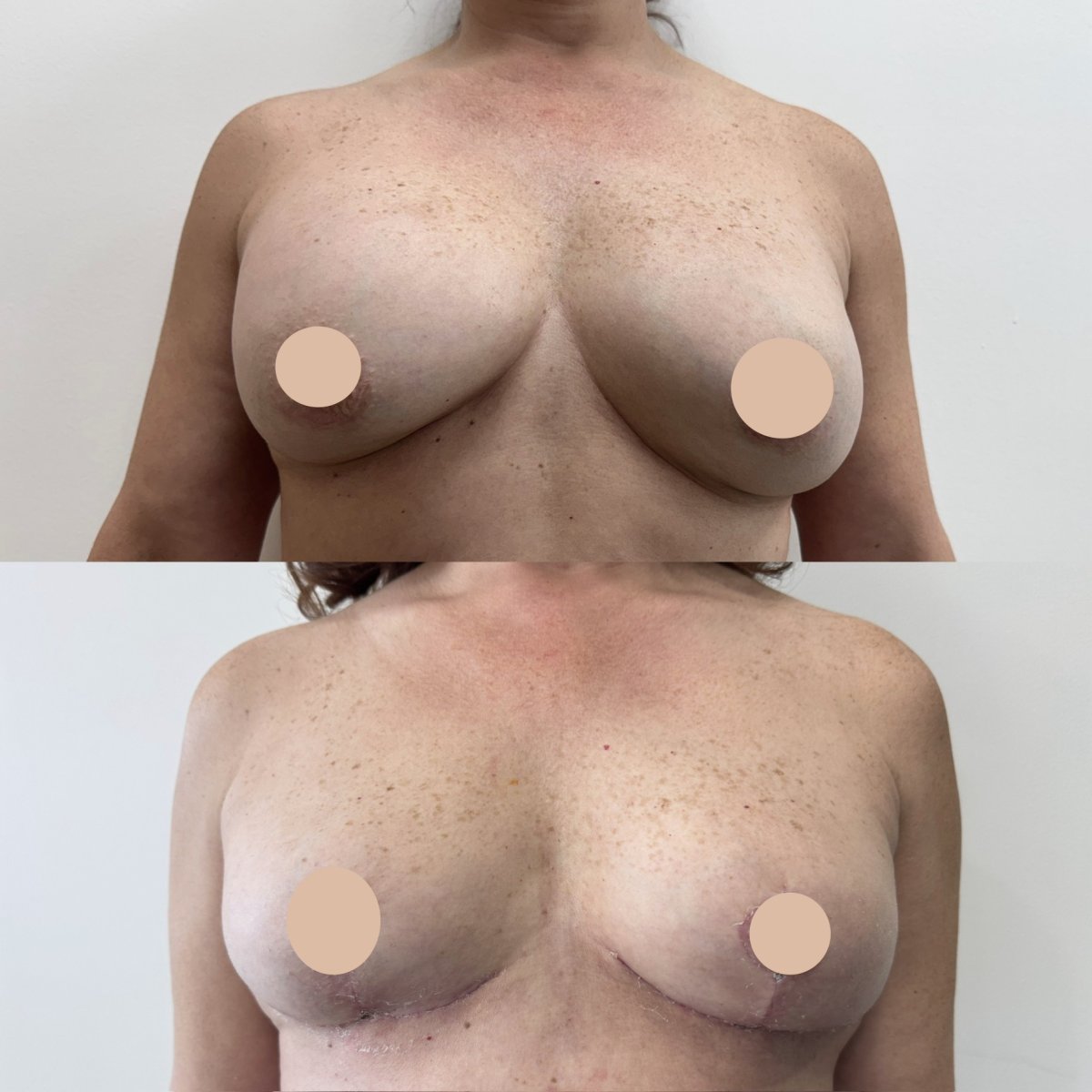 Vorher-nachher-Ergebnisse der Brustimplantatentfernung bei Dr. Yazmin Sánchez Delgado