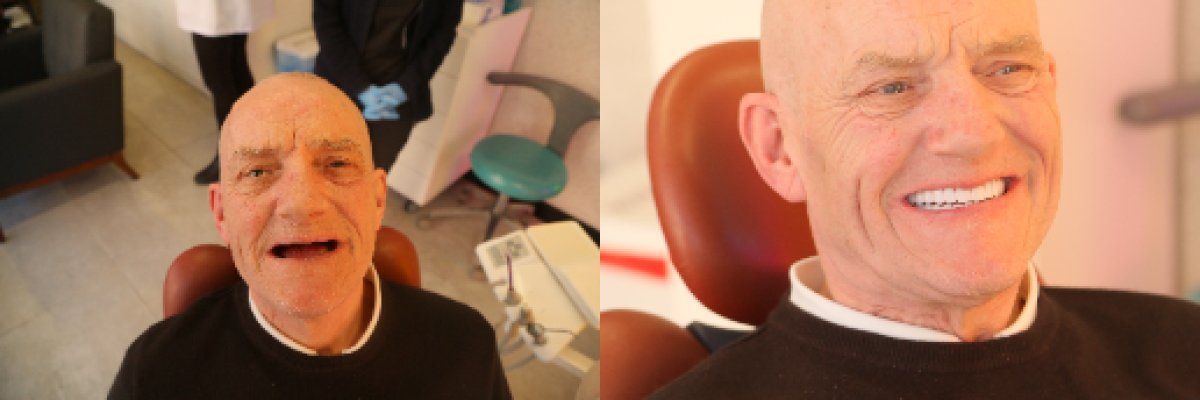 نتائج قبل وبعد زراعة الأسنان لرجل مسن، ابتسامة مستعادة في عيادة الأسنان