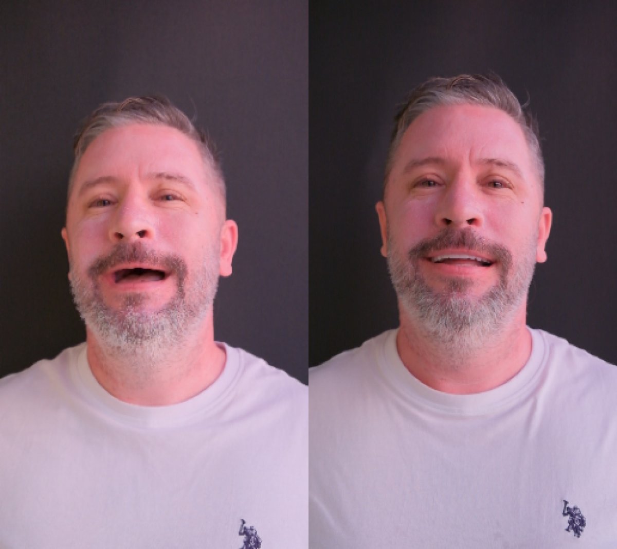 Before and after smile makeover results – improved teeth and confident smile transformation