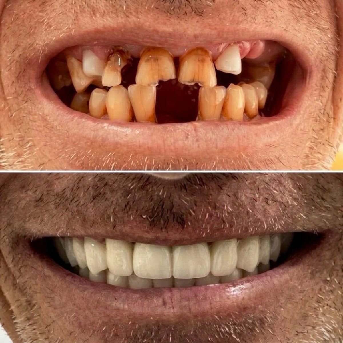 نتائج قبل وبعد جسر الأسنان الزركوني في عيادة سبانداريشفيلي، استعادة الابتسامة