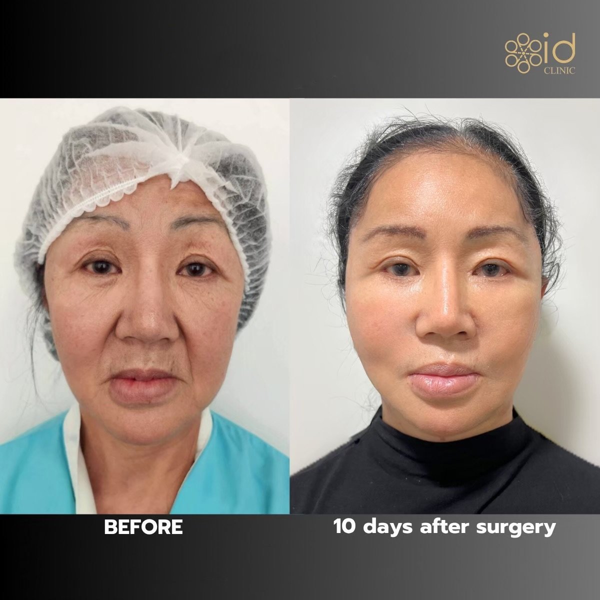 Resultados de lifting facial antes y después en ID Clinic Bangkok, rejuvenecimiento en 10 días